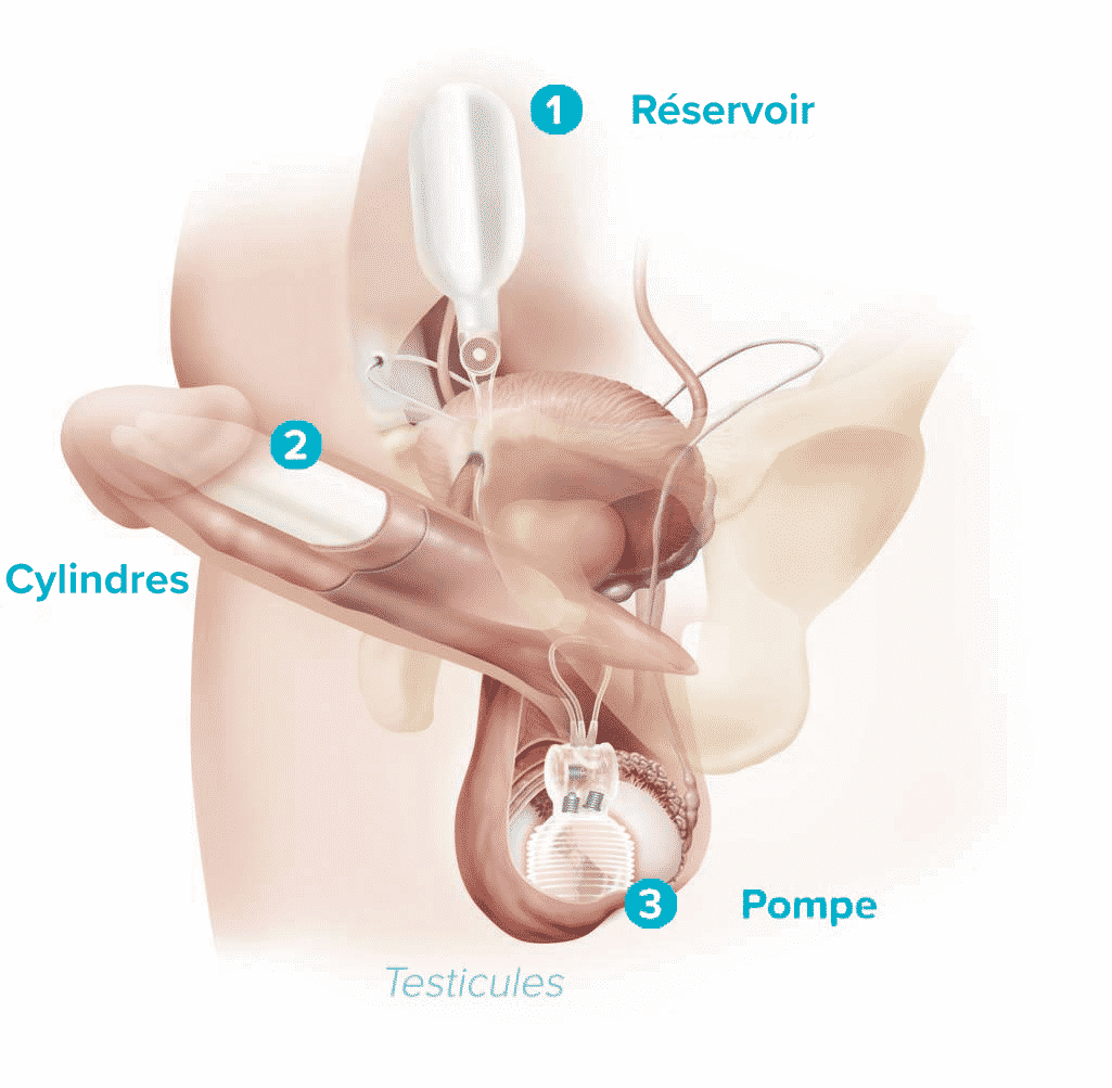 Comment limplant pénien gonflable fonctionne-t-il ? | Erection et Sexualité